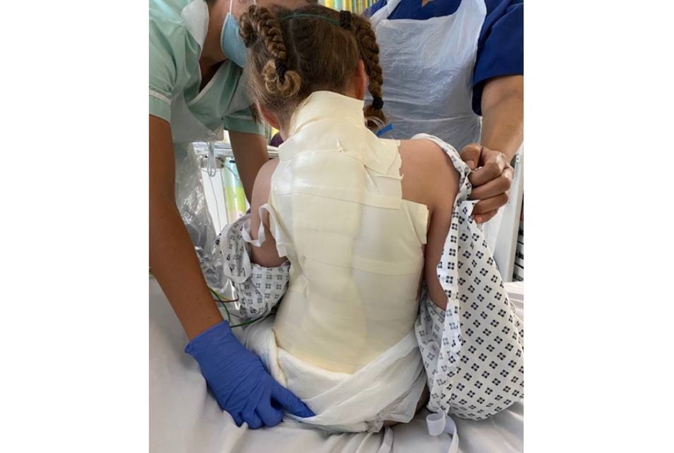 After surgery Julies scoliosis story 